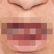 Imagen para el artículo titulado La peligrosa afección de la gingivitis de fresa: cuando las encías están tan inflamadas que parecen a punto de explotar